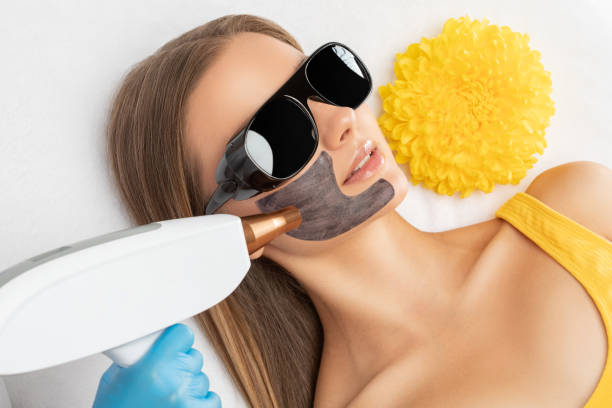 Does Laser Carbon Peel Minimize Fine Lines Safely