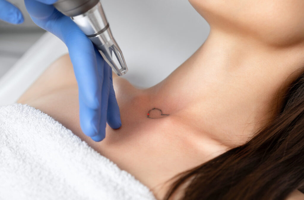 Does Laser Tattoo Removal Require Special Aftercare?