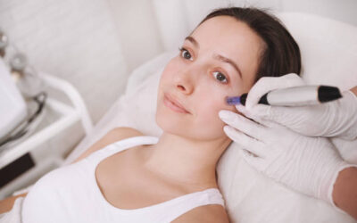 Does Microneedling Work for Early Aging Signs?