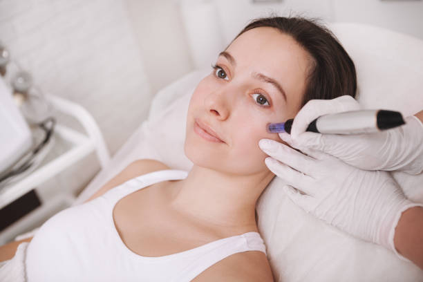 Does Microneedling Work for Early Aging Signs?