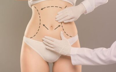 Does Mini Abdominoplasty Flatten Stomach?