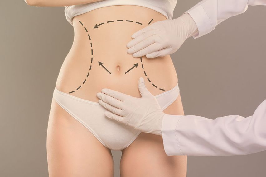 Does Mini Abdominoplasty Flatten Stomach?