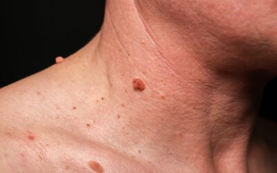 Does Skin Lesion Removal Remove Moles Too