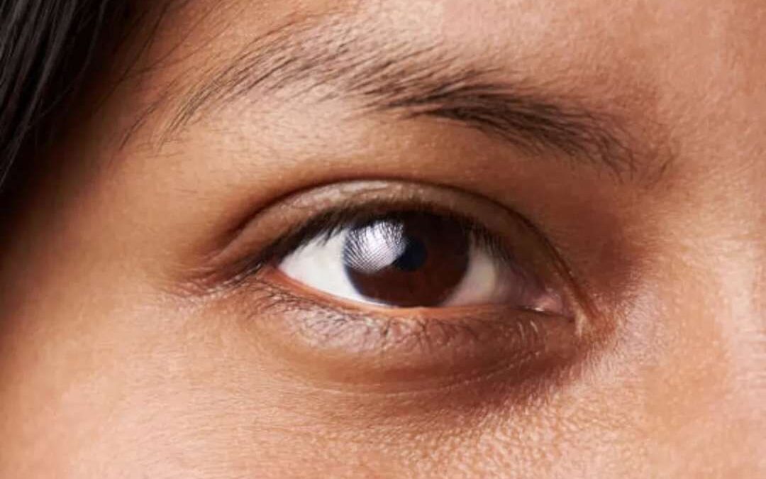 How Does Dark Circles Treatment Rejuvenate Eyes?