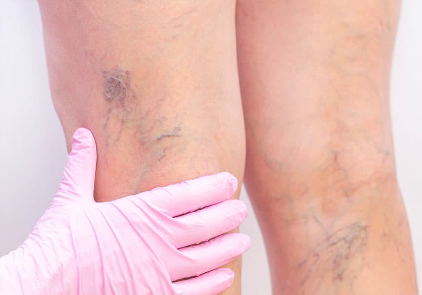 How Does Sclerotherapy Improve Vein Appearance