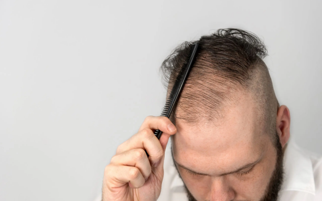 How FUE Hair Transplant Achieves Seamless Growth