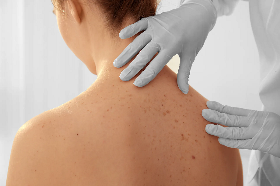 How Long Does Skin Tag Removal Take to Heal?