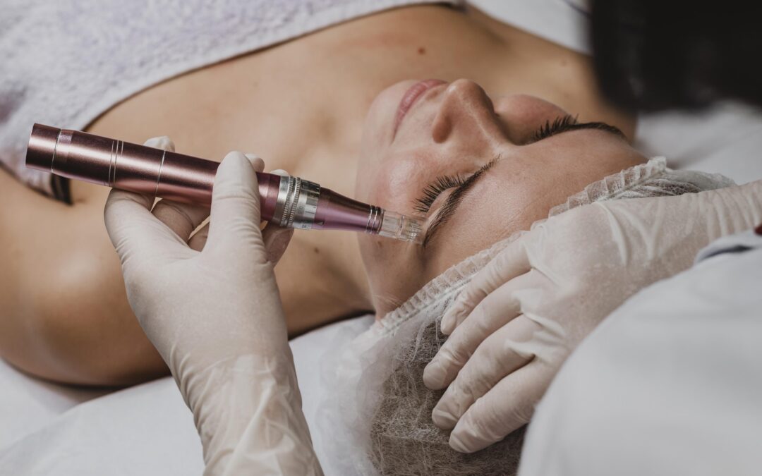 How Microneedling for Acne Scars Repairs Skin