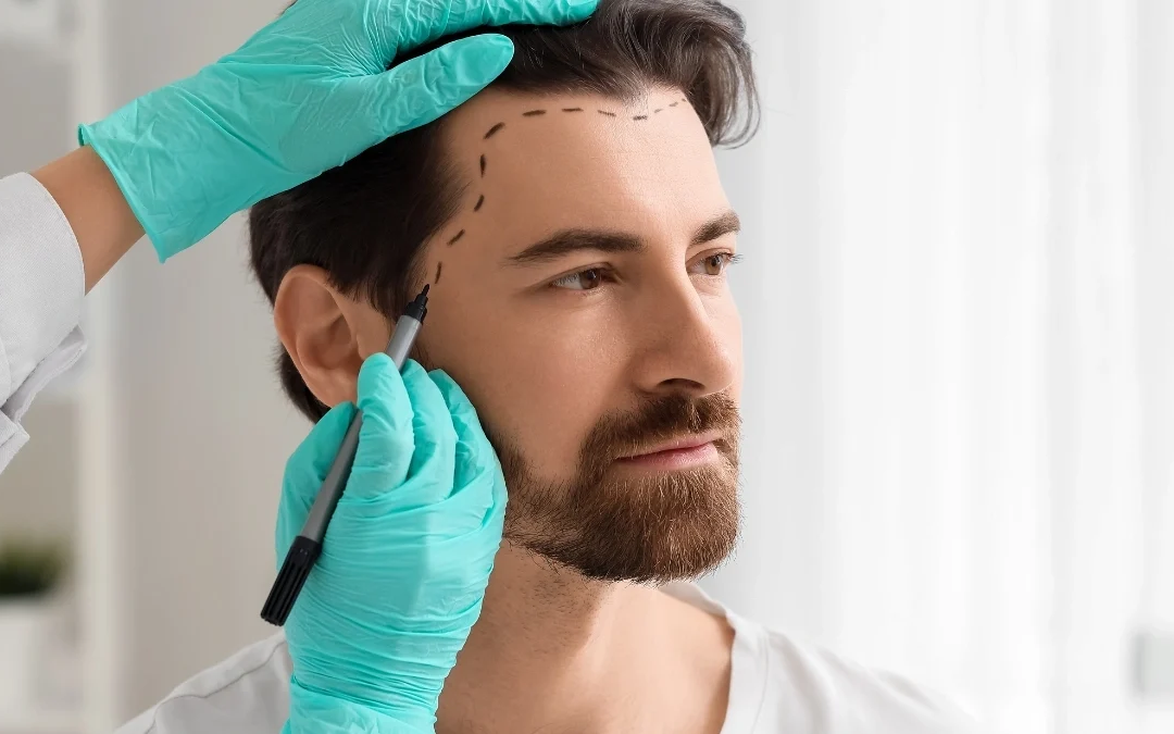 How Reliable Are Scarless Hair Transplant Results?