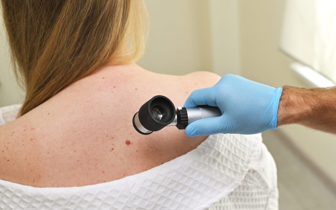 Is Dermoscopy Mole Evaluation Effective for Moles?