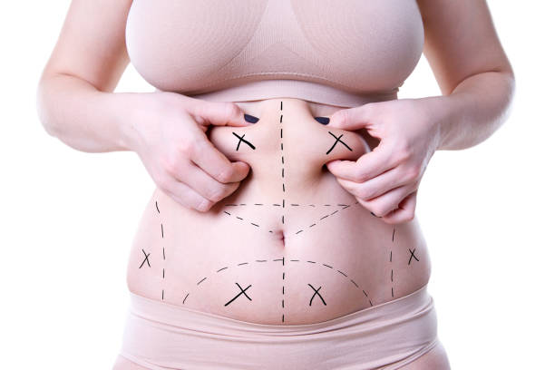 Is Mini Tummy Tuck the Right Cosmetic Choice?