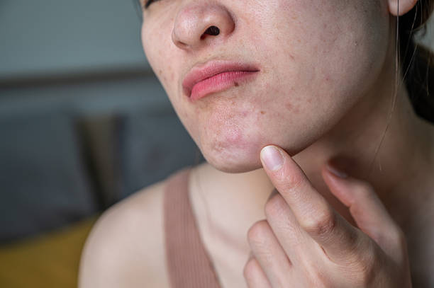 What Makes Laser Acne Scar Treatment Popular?