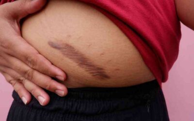 What Should You Expect From Keloid Treatment