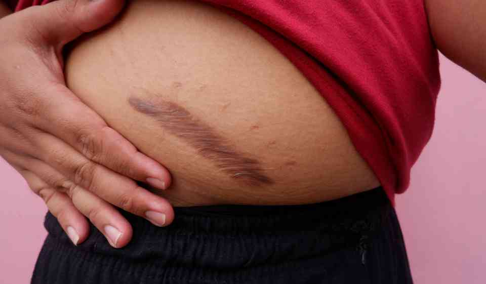 What Should You Expect From Keloid Treatment