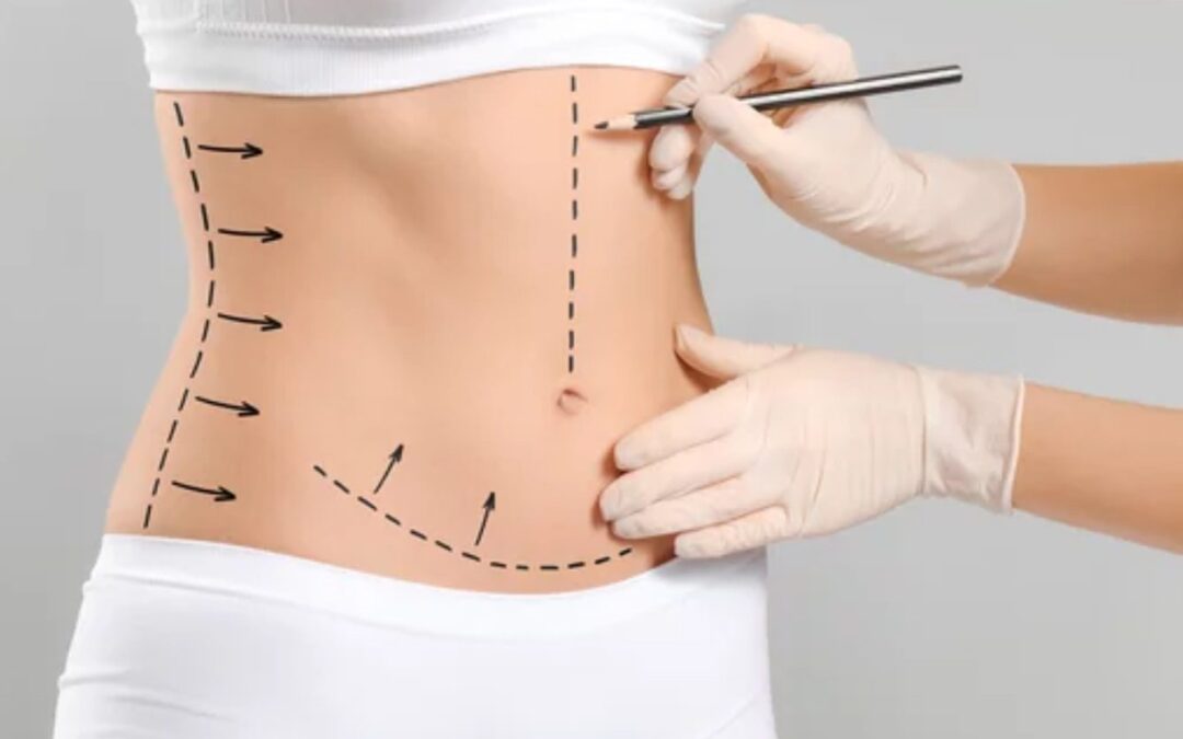 What Should You Know Before GPS Laser Liposuction?