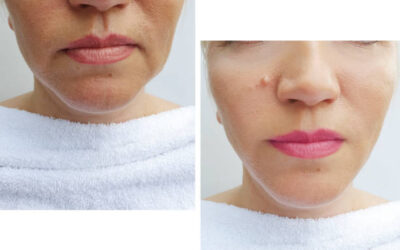 Double Chin Removal in Abu Dhabi with Minimally Invasive Methods