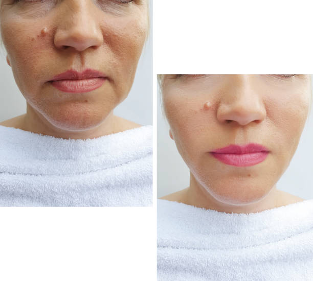 Double Chin Removal in Abu Dhabi with Minimally Invasive Methods