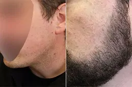 أفضل تقنيات زراعة شعر اللحية المستخدمة في دبي: دليل شامل للمظهر المثالي
