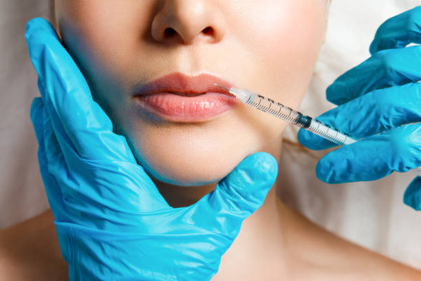Are Russian Lip Fillers Good for Mature Lips?