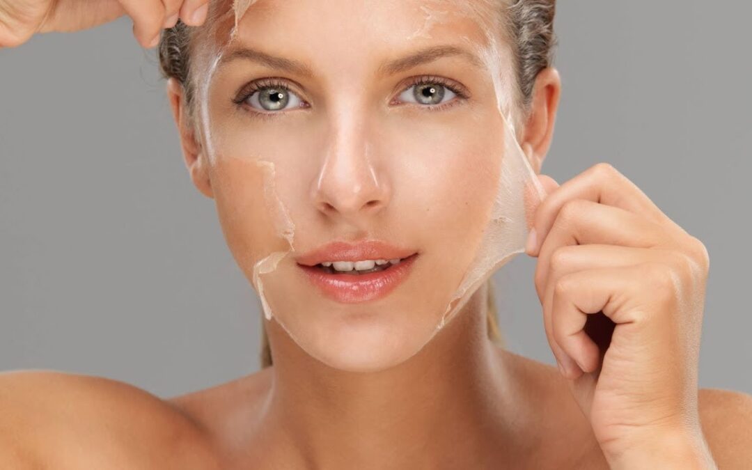 Can Chemical Peels Treat Hormonal Acne Scars?