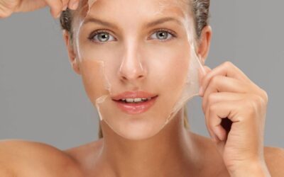 Can Chemical Peels Treat Hormonal Acne Scars?