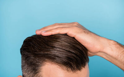 Can Hair Transplant Cost Affect Treatment Choice?