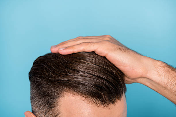 Can Hair Transplant Cost Affect Treatment Choice