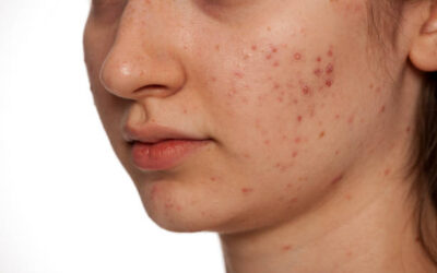 Can Laser Acne Scar Treatment Reduce Red Acne Marks?