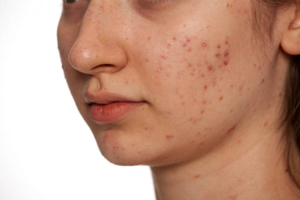 Can Laser Acne Scar Treatment Reduce Red Acne Marks