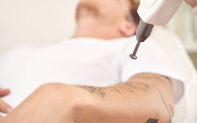 Can Laser Tattoo Removal Remove Amateur Tattoos?