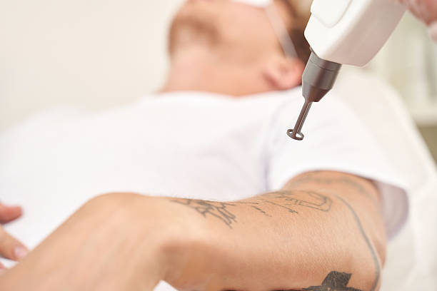 Can Laser Tattoo Removal Remove Amateur Tattoos?