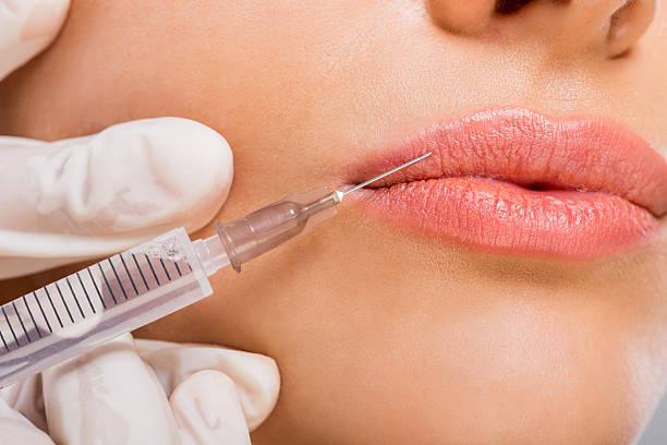 Can Lip Fillers Injection Define Your Lip Borders