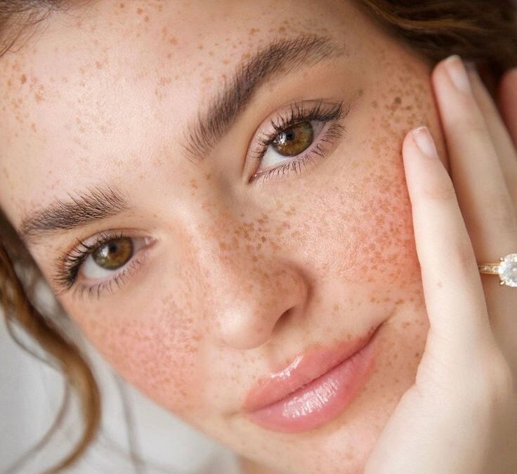 Can Melasma Treatmen Prevent Melasma Recurrence?