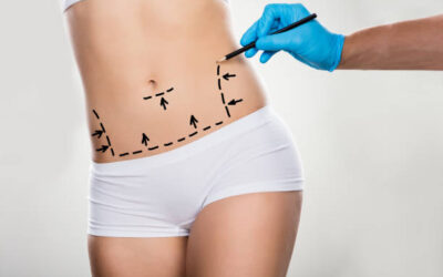 Can Mini Tummy Tuck Improve Clothing Fit?