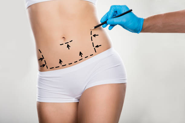 Can Mini Tummy Tuck Improve Clothing Fit