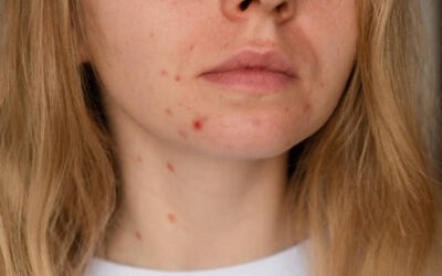 Does Acne Treatment Help with Deep Acne?