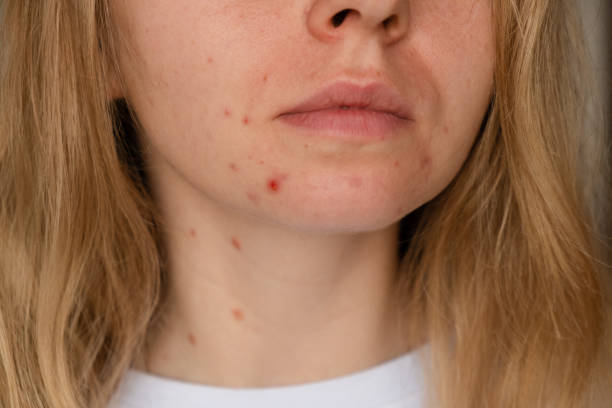 Does Acne Treatment Help with Deep Acne