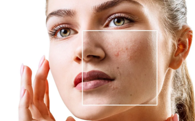 Does Acne Treatment Work for Hormonal Acne?