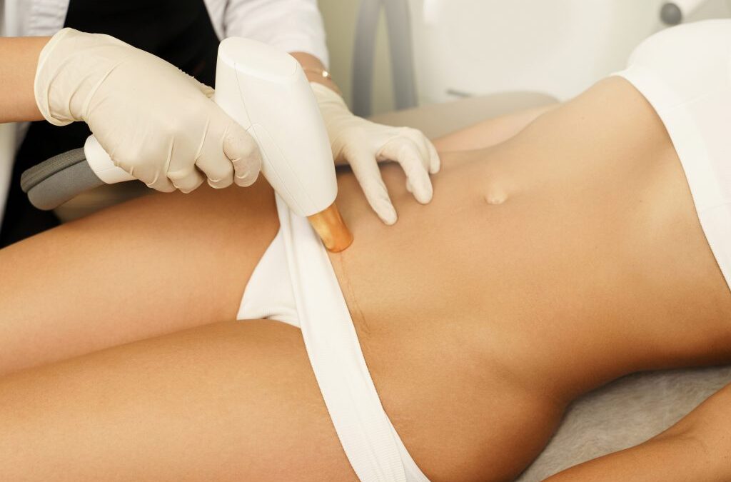 Does Bikini Laser Hair Removal Reduce Ingrown Hairs?