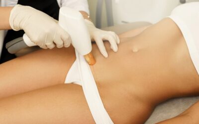 Does Bikini Laser Hair Removal Reduce Ingrown Hairs?