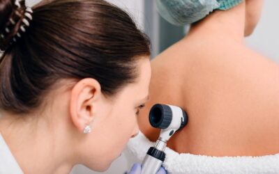 Does Dermoscopy Mole Evaluation Need Preparation?
