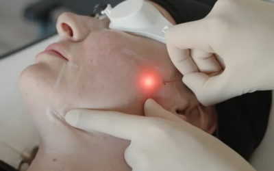 Does EndoLift Help Reduce Facial Fat Safely