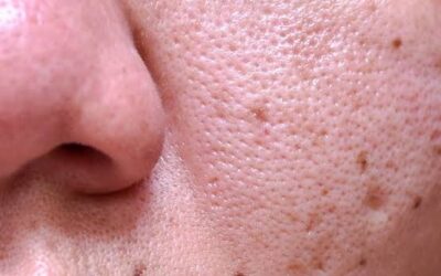 Does Large Pores Treatment Boost Skin Texture?