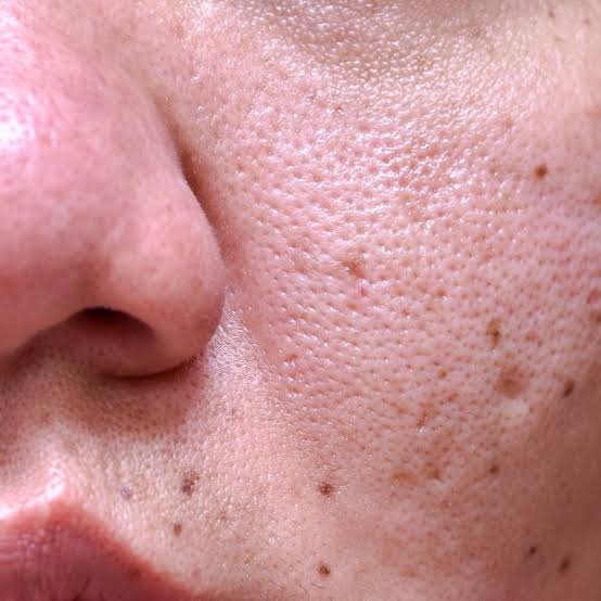 Does Large Pores Treatment Boost Skin Texture?