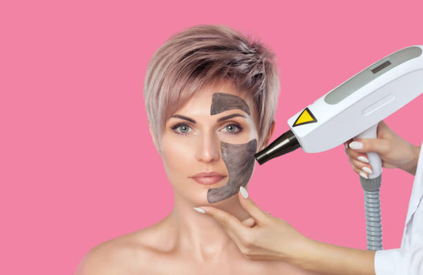 Does Laser Carbon Peeling Even Out Skin Tone