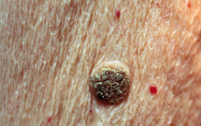 Does Seborrheic Keratosis Treatment Really Work?