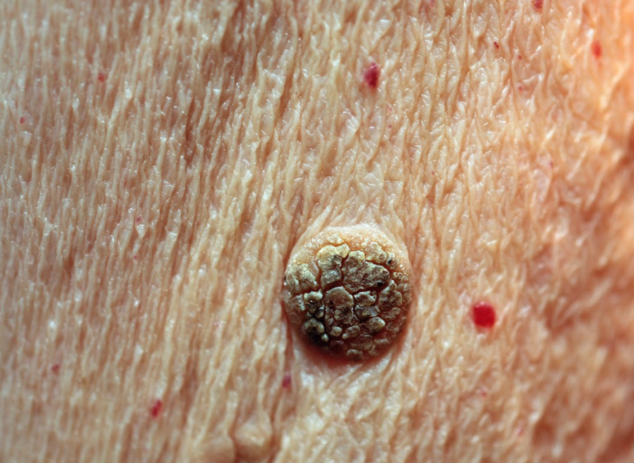 Does Seborrheic Keratosis Treatment Really Work?
