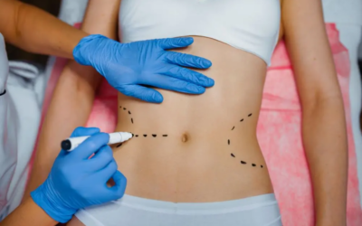 Does Tummy Tuck Help Flatten the Stomach?