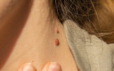 How Can Skin Lesion Removal Boost Confidence