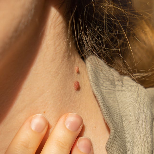 How Can Skin Lesion Removal Boost Confidence